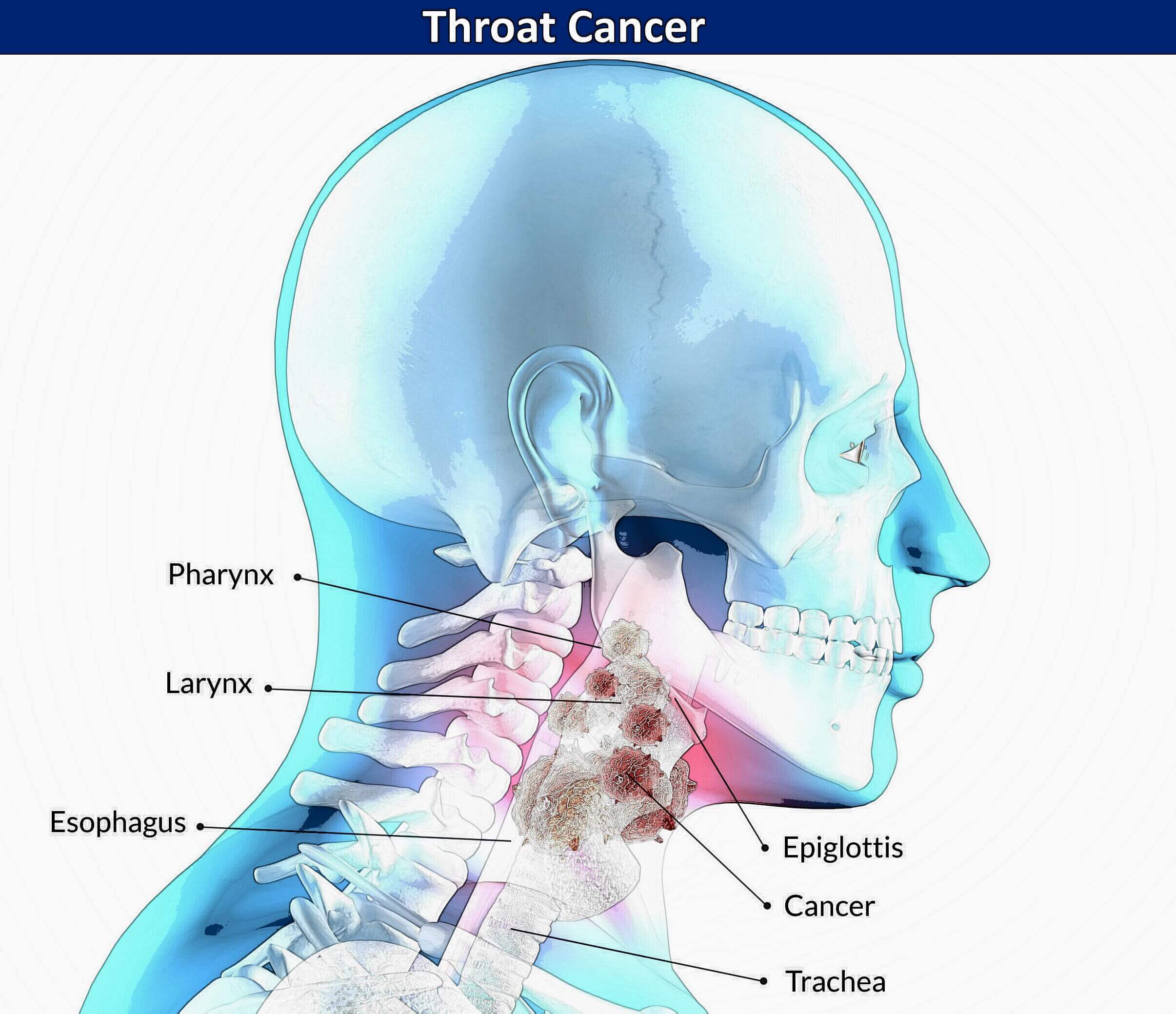 Diagramatic image of a head with area that throat cancer can develop