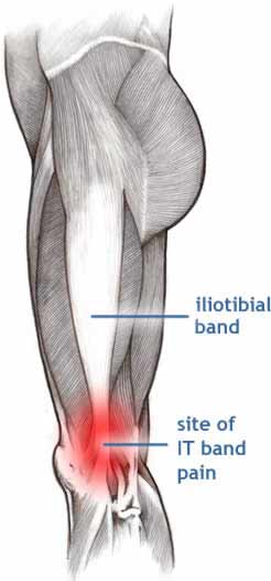 Ilio-tibial Band Syndrome (ITB)