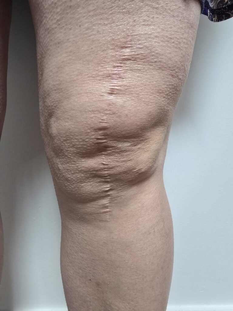 scar from knee replacement surgery
