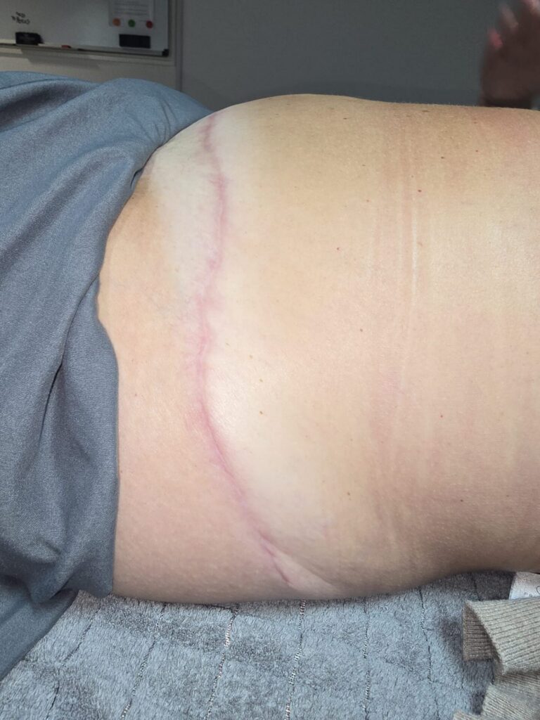 Woman with scar from tummy tuck